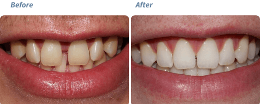 Before and after Invisalign treatment