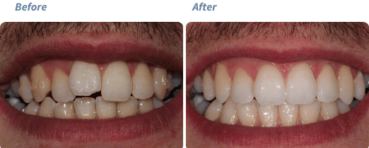 Before and after Invisalign treatment