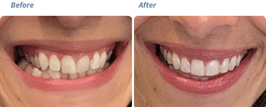 Before and after Invisalign treatment