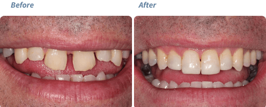 Before and after Invisalign treatment